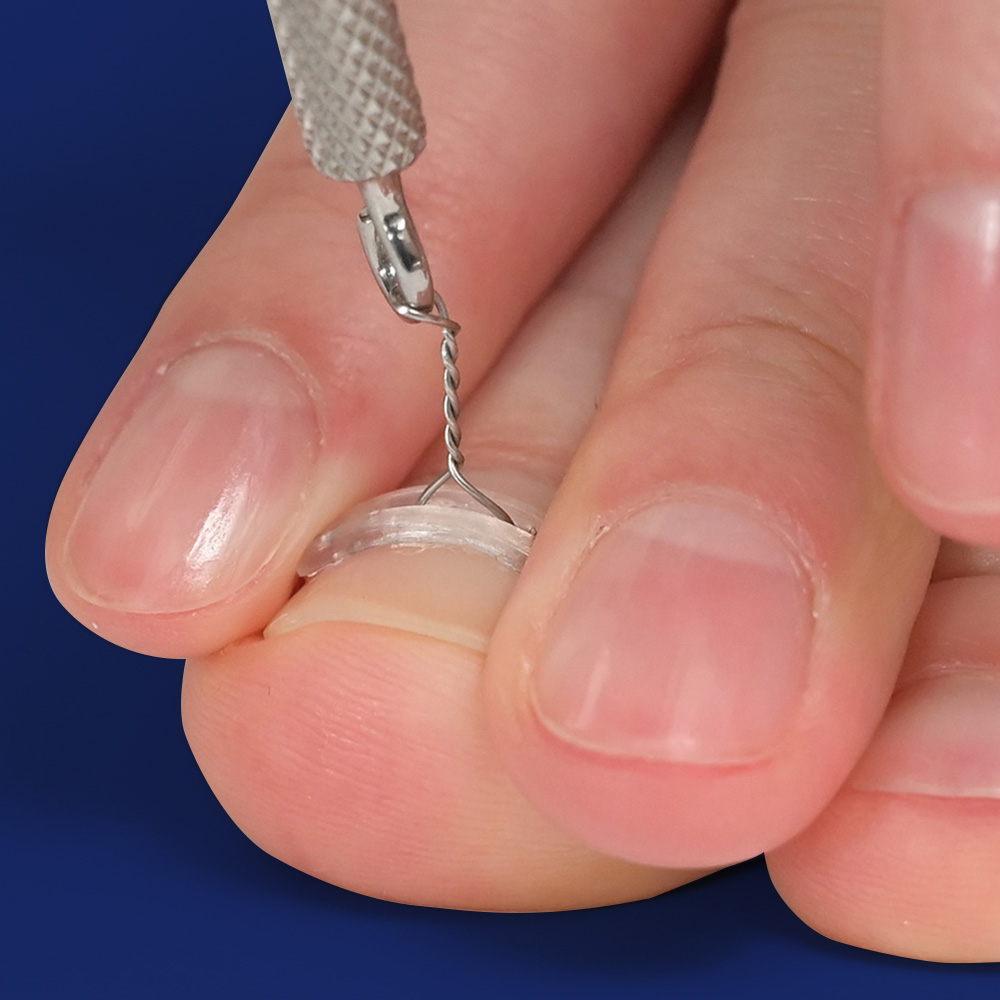 퍼펙토 픽스 내성발톱 교정기 와이어 의료기기 파고드는 발톱 자가치료 후크 세트, 1세트 51,900원