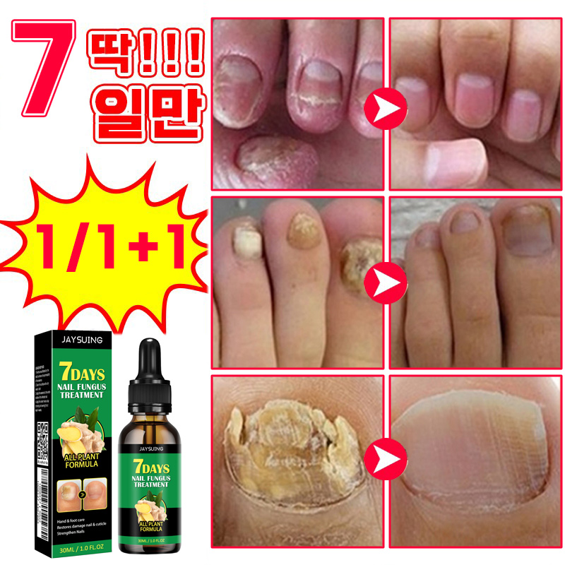 [빠른배송] 발톱 거품나는앰플 문제성발톱 앰플 발톱 곰팡이 한번에끝내는 손발톱 영양제 보장증정 12,800원