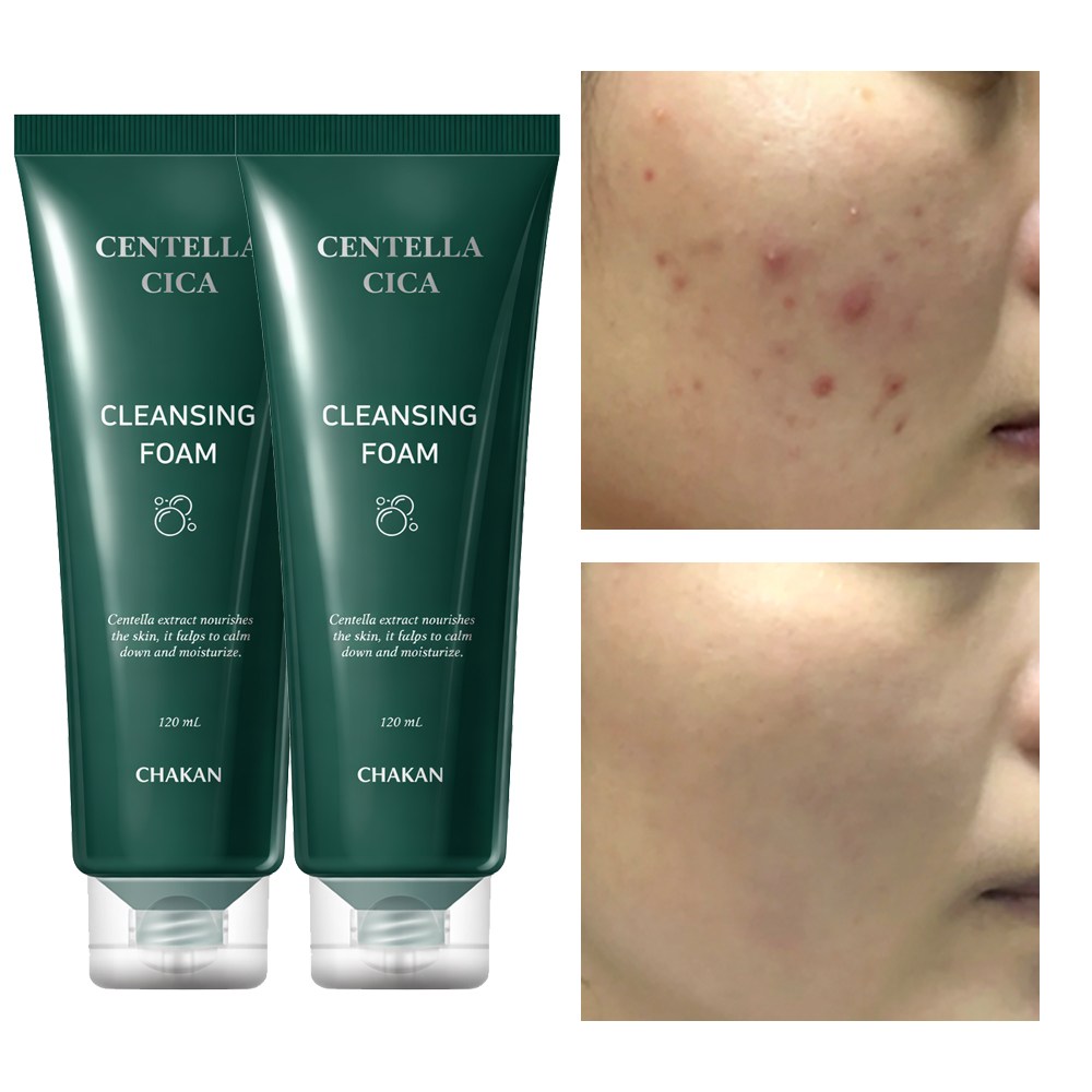여드름 기능성 클렌징폼 좁쌀 아크네 사춘기 청소년 화장품 수부지 센텔라 시카 클렌저, 120ml, 2개, 현재가 27,000원