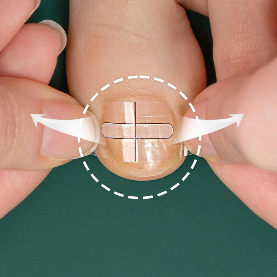 10매+10매 퍼펙토 내성발톱 교정기 스트립 교정팁 의료기기 자가치료 세트, 20개 19,500원