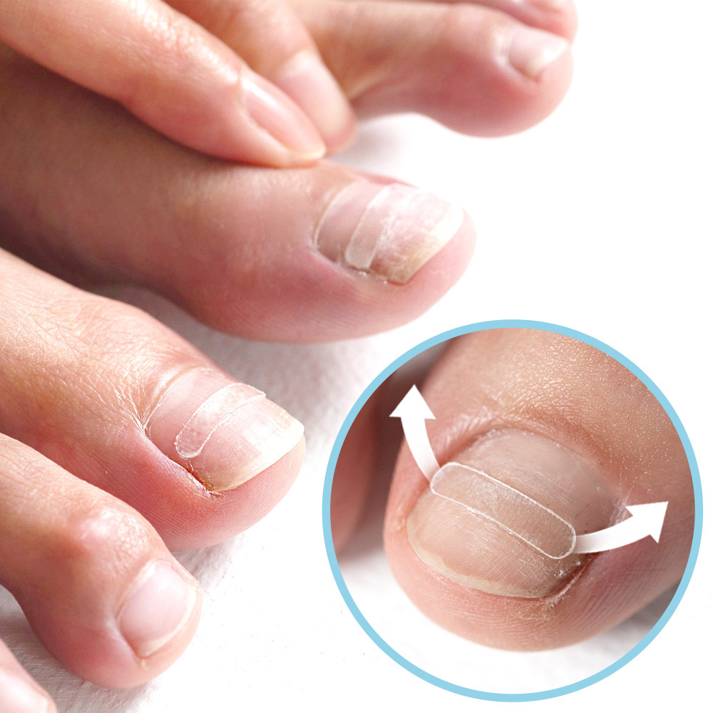 특허인증 의료기기 퍼펙토 내성발톱 교정기 스트립 의료기기 자가치료 교정 세트, 1세트 15,800원